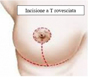 Incisione a T rovesciata per riduzione volumetrica del seno