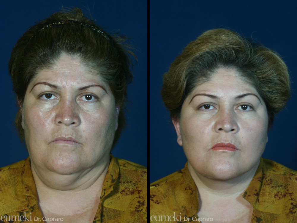 lifting viso e collo