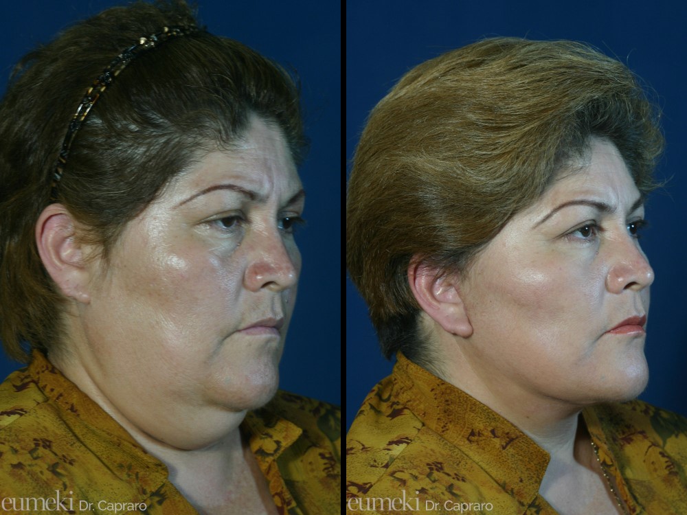 lifting viso e collo