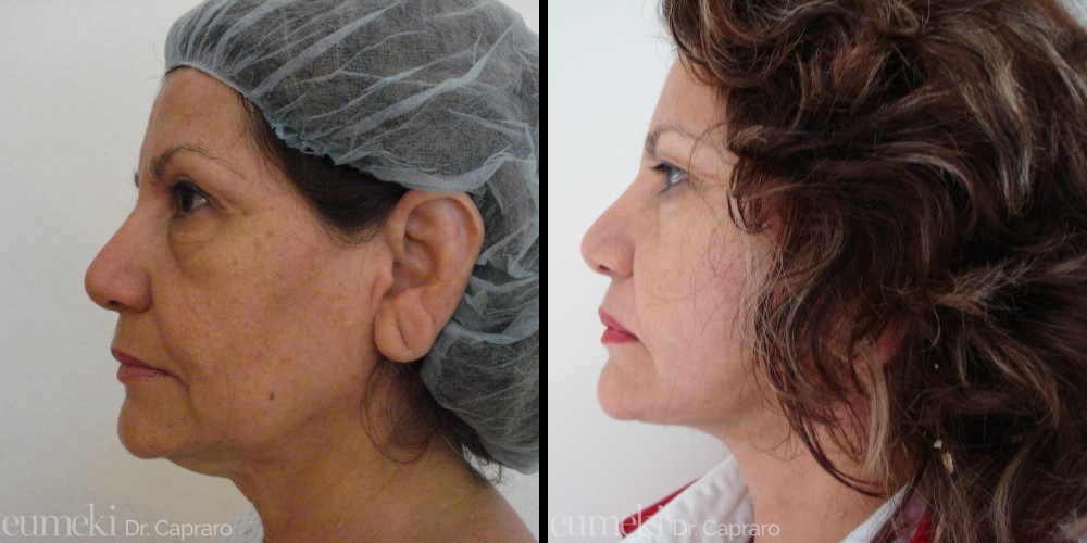 lifting viso e collo