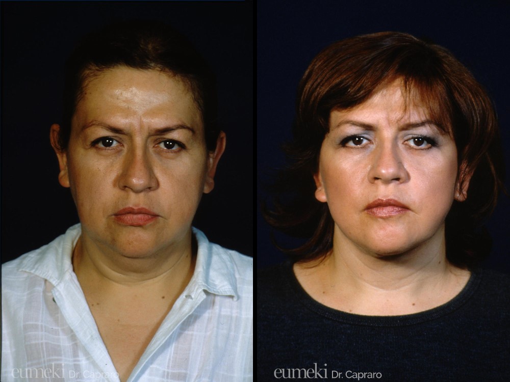 lifting viso e collo