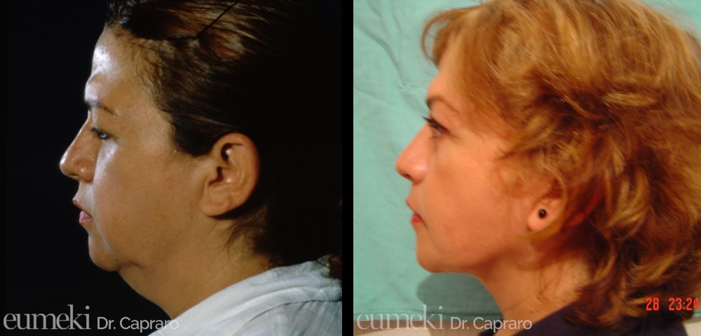 lifting viso e collo