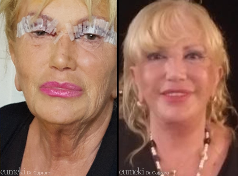 lifting viso e collo blefsaroplastica