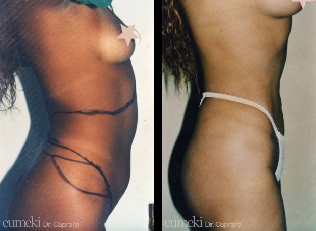 liposcultura1-latodx-desk