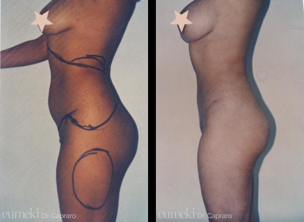 liposcultura1-latosx-desk