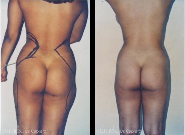 liposcultura1-retro-desk