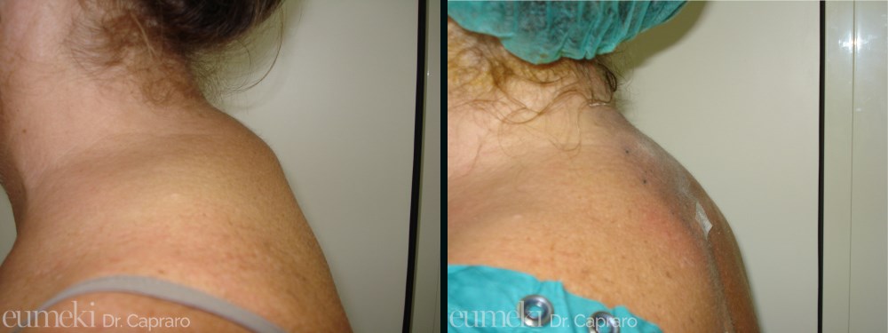 liposuzioneschiena1-desk