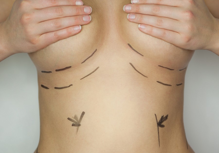 intervento di mastoplastica