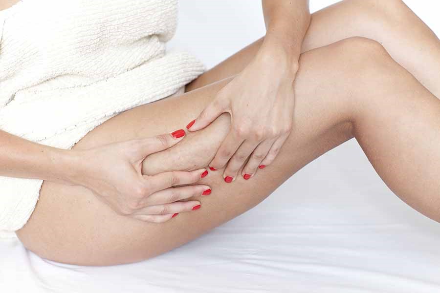cellulite