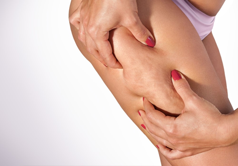 cellulite