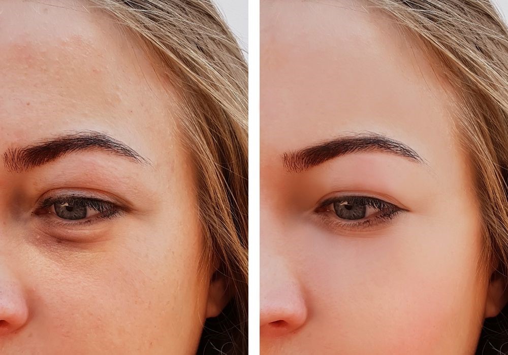 filler occhiaie before and after